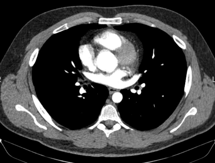 CT Chest contrast
