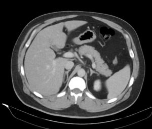 CT abdomen normal status