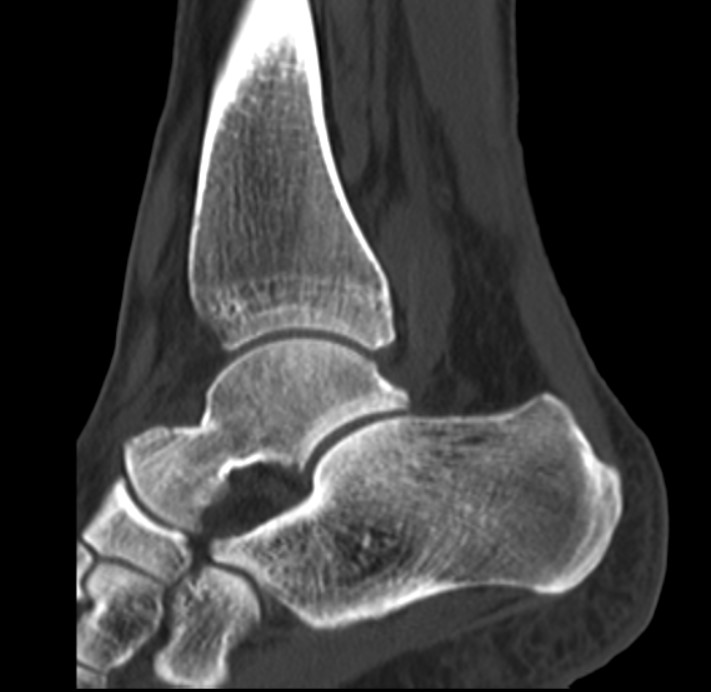 CT Scan - ankle