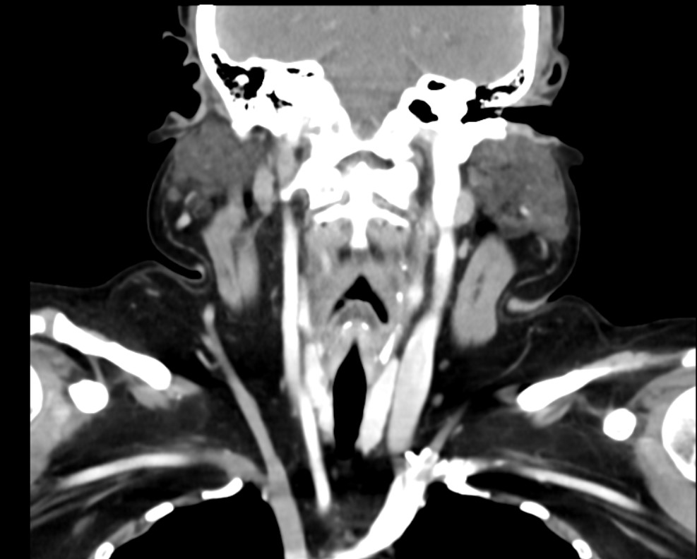 CT Scan - Neck