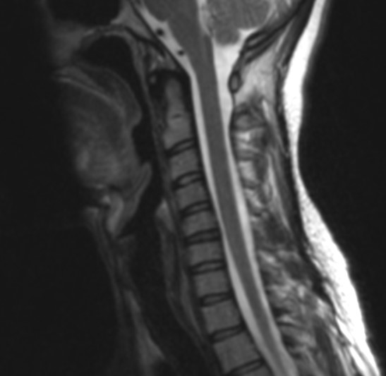 MR cervical thumb