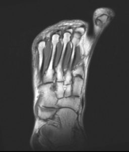 MR foot thumbnail