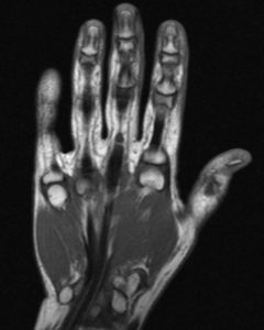 MRI Scan - Hand