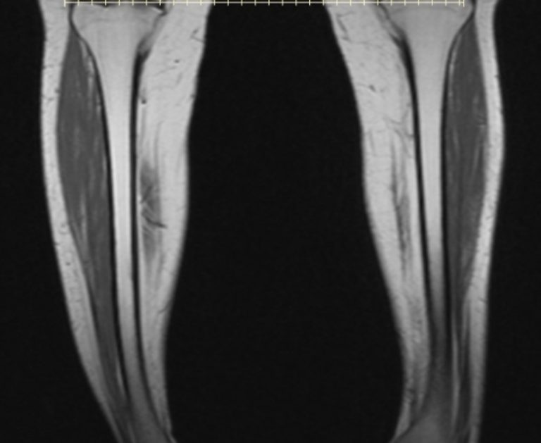 MRI Lower Leg Mediphany