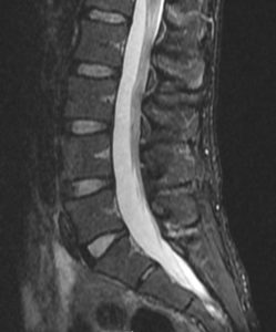 MR lumbar spine