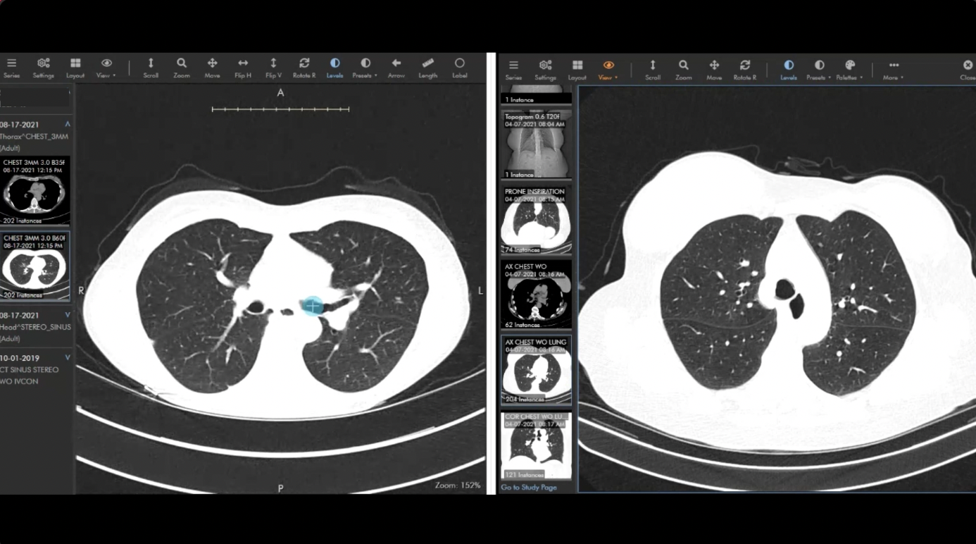 Chest/Lung CT