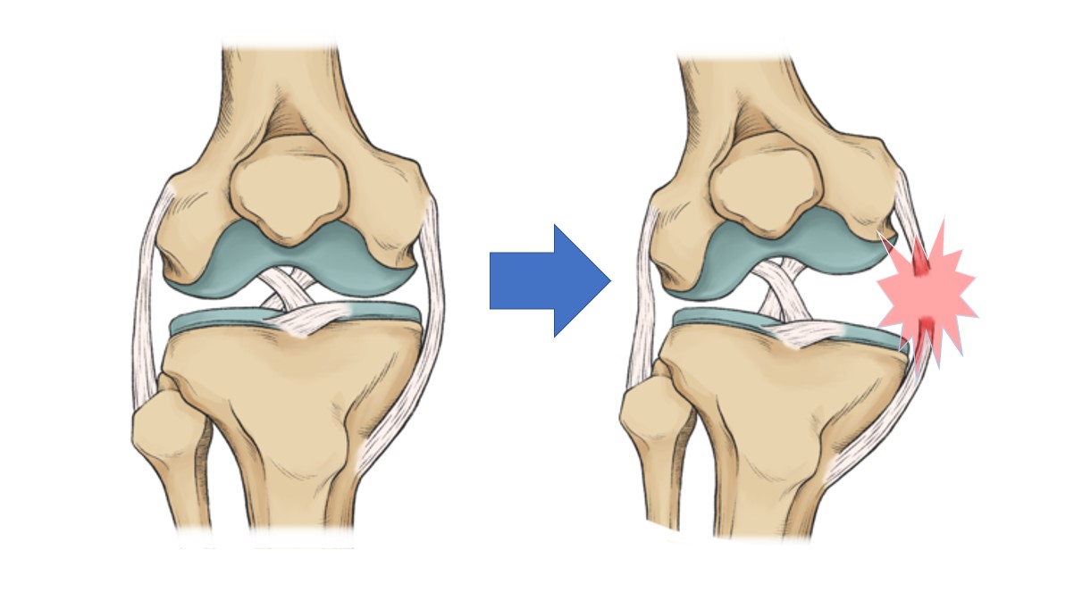 Medial Collateral Ligament (MCL) Sprain - Mediphany