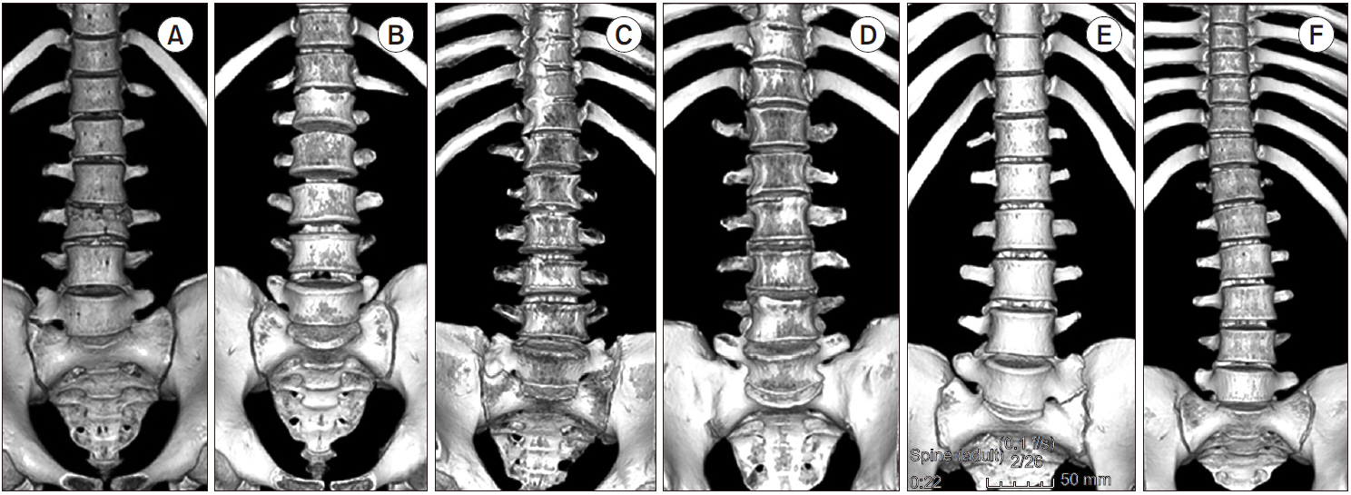 transitional spinal anatomy