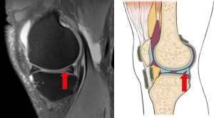 meniscus tear for blog