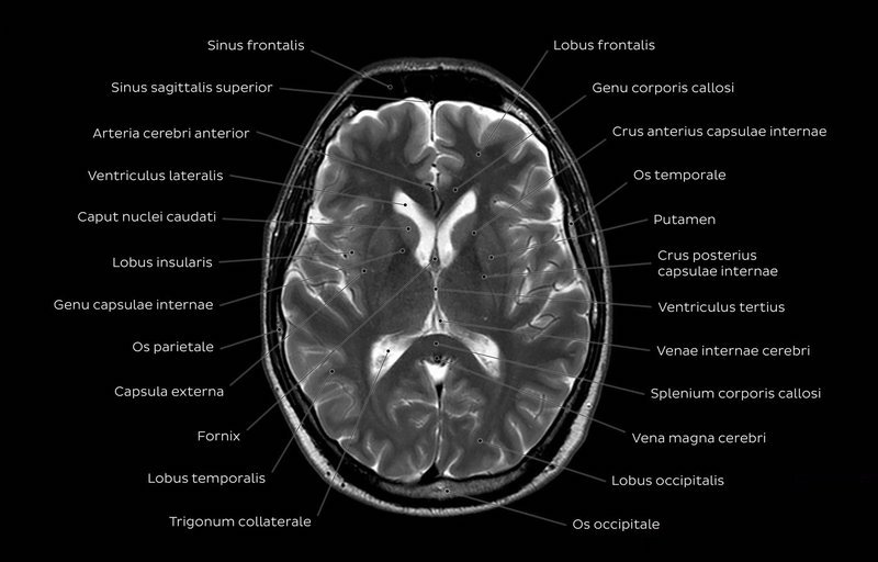 how to read mri images on cd