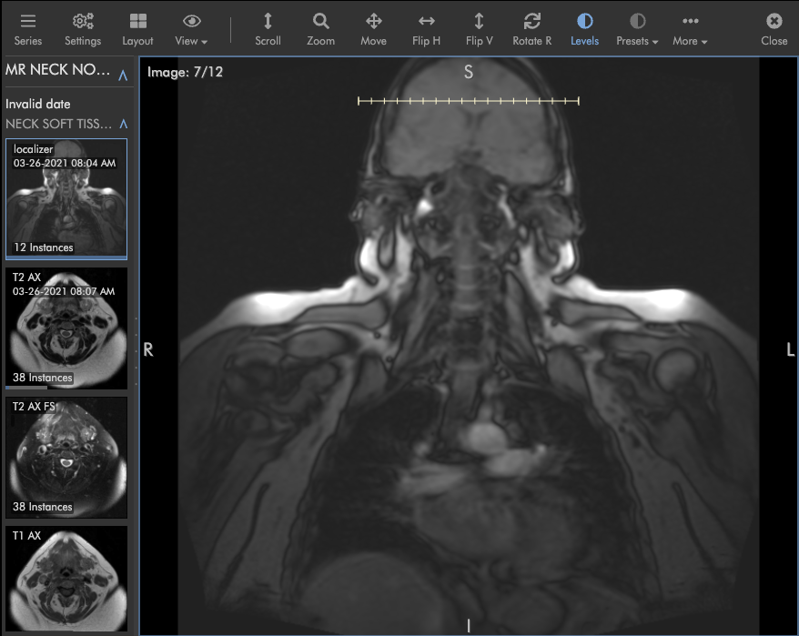 MRI Neck