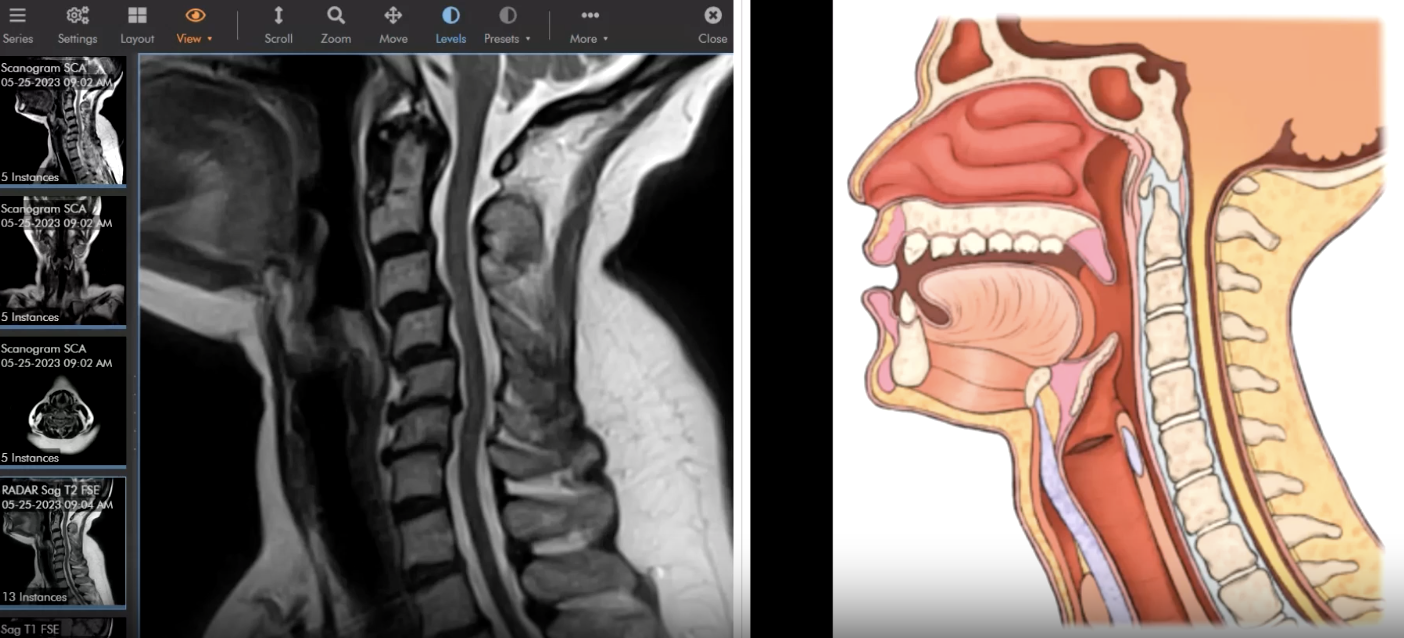 Cervical spine: Aggravation of existing disc disease