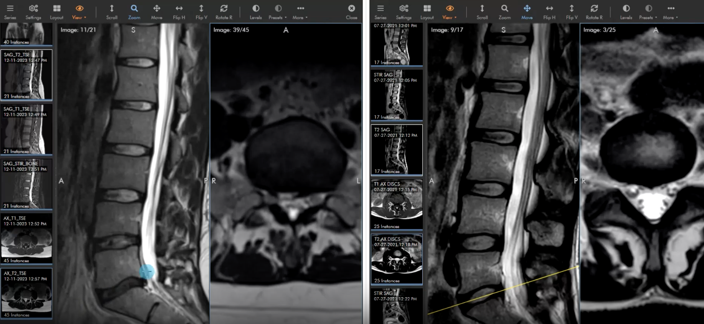 Lumbar spine: Acute disc herniation