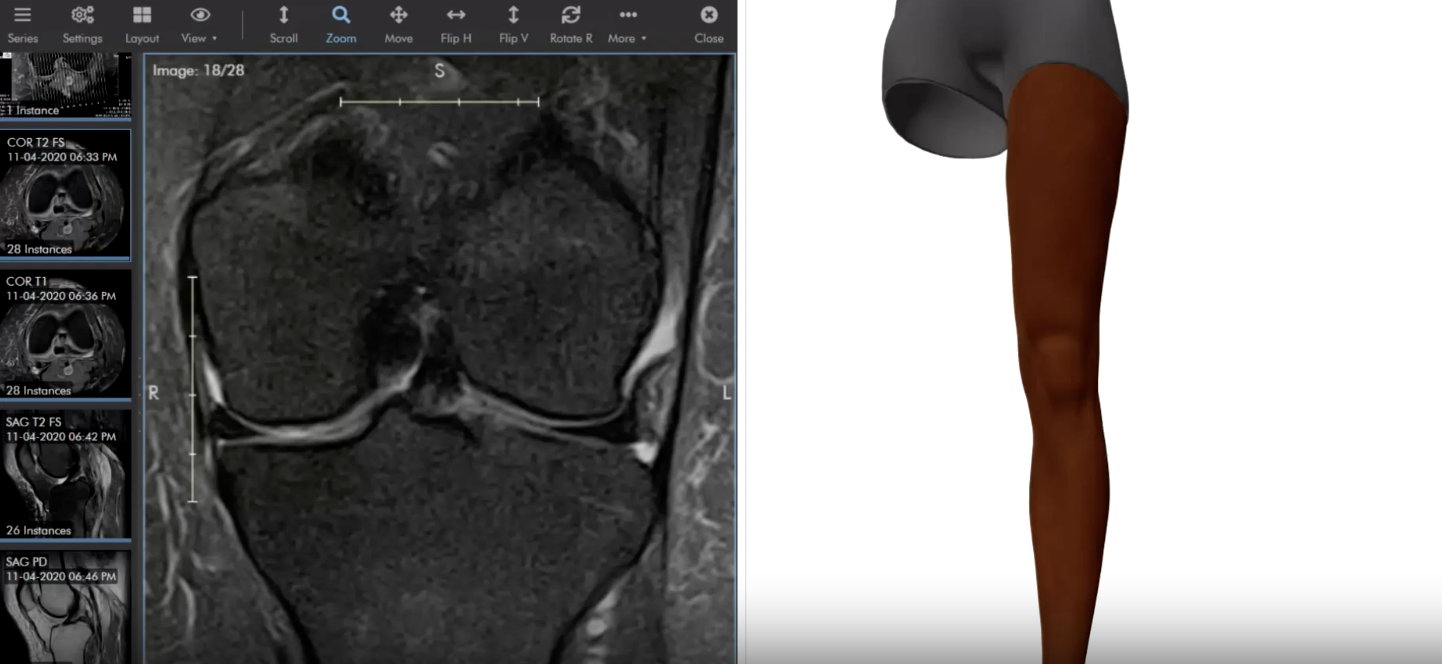 Meniscus tear, ligament injury and acute bursitis