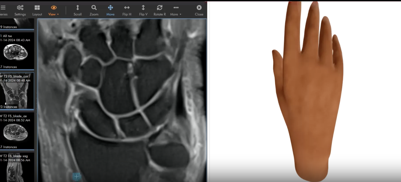 Wrist: Acute tear of the triangular fibrocartilage